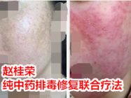 解答：能用他克莫司软膏治疗激素依赖性皮炎吗？