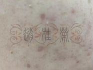 导致痤疮发生的各种原因症状归总