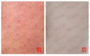 赵桂荣美丽在线|| 看看她的激素依赖性皮炎,是用这种方法好转的！