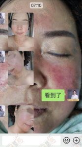 外敷赵桂荣原液，调理激素脸30天：皮肤变化观察