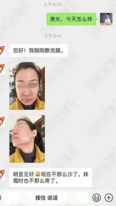 【治疗案例】激素脸不断好转，不痒了！看看她是怎么做到的~